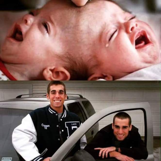 Image result for Remember The Conjoined Twins Dr Ben Carson Separated In 1987??? See What They Look Like Now (PHOTOS)